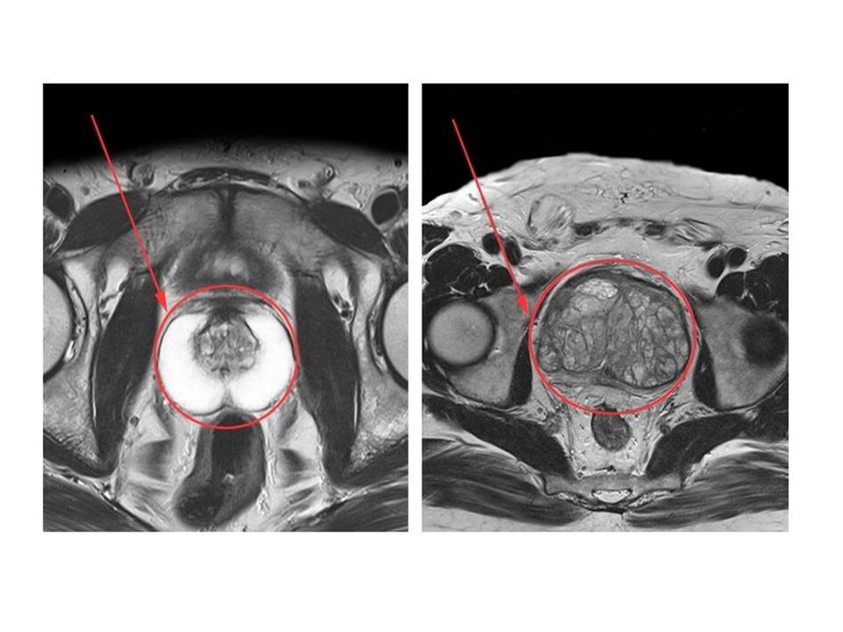 Veselīgas (kreisās) un iekaisušas (labās) prostatas salīdzinājums MRI attēlos